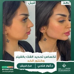 <p>&nbsp;</p>

<p>تكساس تحديد الفك بالفيلر وكنتور الخد</p>