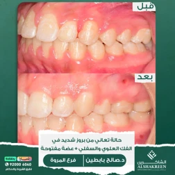 <p>&nbsp;</p>

<p>حالة تعانى من بروز كبير فى الفك العلوى والسفلى بالاضافة&nbsp;</p>

<p>الى عضة مفنوحة&nbsp;</p>