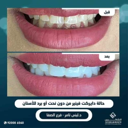 <p><a href="https://alshakreen.net/public/ar/offers/Dental-offers?page=1">حالة دايركت فينير من دون نحت أو برد للأسنان</a><br />
&nbsp;</p>