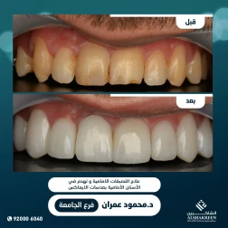 <p><a href="https://alshakreen.net/public/ar/offers/Dental-offers?page=2">علاج التصبغات الامامية وتهدم في الأسنان الأمامية بعدسات الايماكس</a></p>