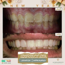<p>تركيبات أسنان لعلاج التصبغات والحصول على إبتسامة هوليوود</p>