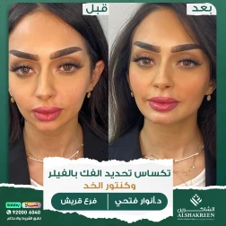 <p>&nbsp;</p>

<p>تكساس تحديد الفك بالفيلر وكنتور الخد</p>