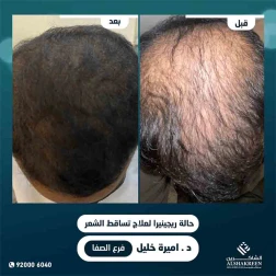 <p>ريجينيرا بديل لزراعة الشعر&nbsp;</p>