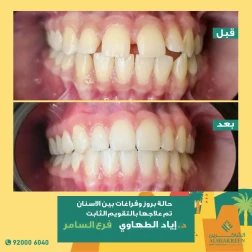 <p>حالة بروز وفراغات بين الاسنان تم علاجها بالتقويم الثابت</p>