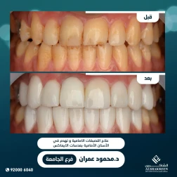 <p><a href="https://alshakreen.net/public/ar/offers/Dental-offers">علاج التصبغات الامامية وتهدم في الأسنان الأمامية بعدسات الايماكس</a></p>

<p>&nbsp;</p>