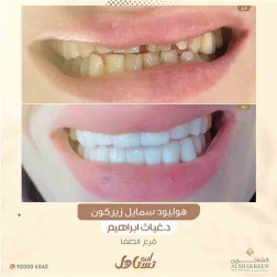 <p>إبتسامة هوليوود</p>

<p>اهم عروض الاسنان&nbsp;</p>

<p><a href="https://alshakreen.net/public/ar/offers/Dental-offers">تنظيف الاسنان&nbsp;</a></p>

<p><a href="https://alshakreen.net/public/ar/offers/Dental-offers?page=2">تقويم الاسنان&nbsp;</a></p>

<p>&nbsp;</p>