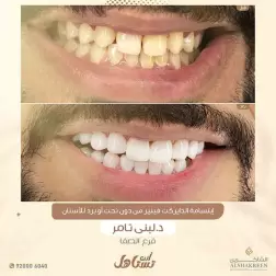 <p><a href="https://alshakreen.net/public/ar/offers/Dental-offers?page=2">إبتسامة الدايركت فينير من دون نحت أو برد للأسنان</a><br />
&nbsp;</p>
