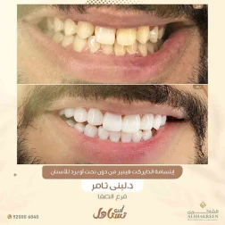 <p><a href="https://alshakreen.net/public/ar/offers/Dental-offers?page=2">إبتسامة الدايركت فينير من دون نحت أو برد للأسنان</a><br />
&nbsp;</p>