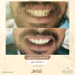 <p>&nbsp;</p>

<p><a href="https://alshakreen.net/public/ar/offers/Dental-offers?page=1">تركيبات زيركون</a></p>
