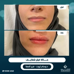 <p>فيلر شفايف&nbsp;</p>

<p>&nbsp;</p>