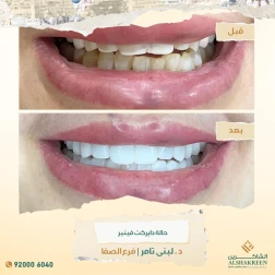 <p>حالة دايركت فينير</p>