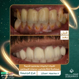 <p>تغيرات تركيبات بورسلين قديمة ومعالجة للثة وتركيب عدسات الايماكس</p>