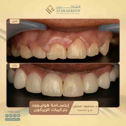 <p><a href="https://alshakreen.net/public/ar/offers/Dental-offers?page=2">إبتسامة هوليوود بتركيبات الزيركون</a><br />
&nbsp;</p>