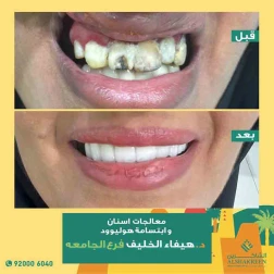 <p>معالجات اسنان وابتسامة هوليوود&nbsp;</p>