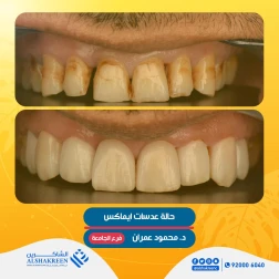 <p><a href="https://alshakreen.net/public/ar/offers/Dental-offers?page=2">حالة عدسات ايماكس</a><br />
&nbsp;</p>